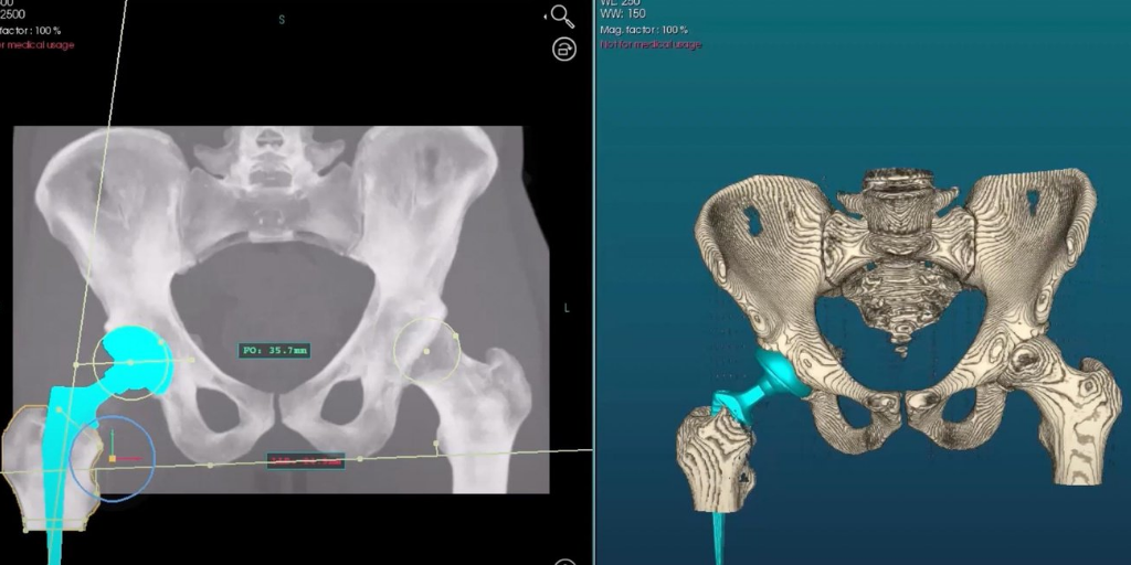 TOTAL HIP ARTHROPLASTY THA visual data 3